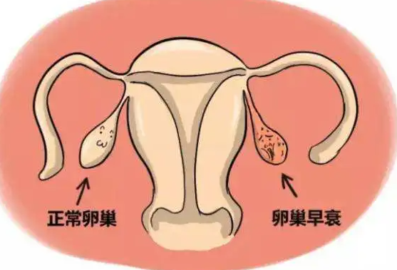 卵巢早衰治疗方法.png