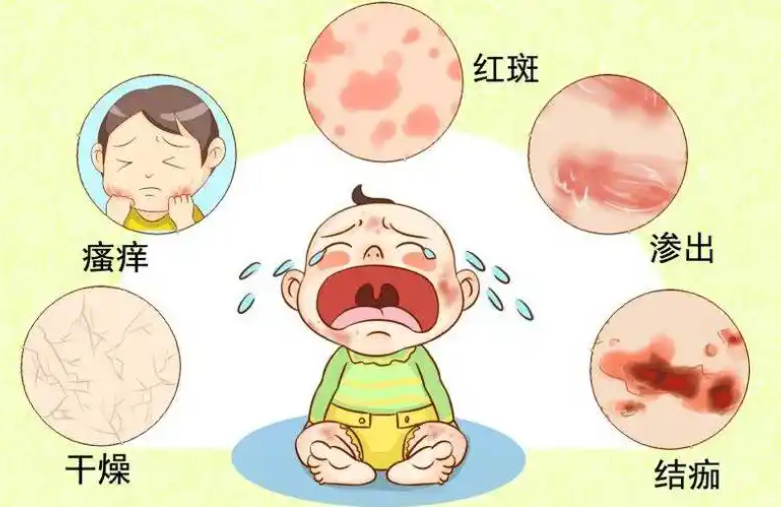 宝宝湿疹是常见现象