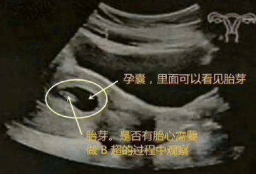 试管成功妊娠胎芽孕周对照表