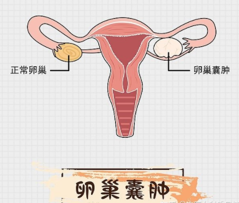 卵巢囊肿术后多久可以试管？卵巢囊肿影响试管成功率吗？