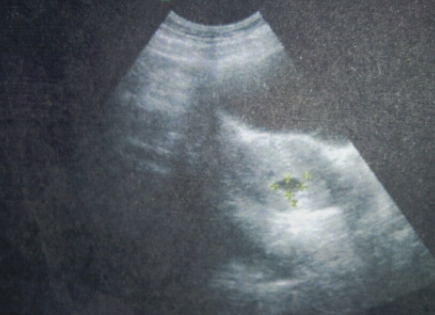 怀孕6周没有孕囊只有暗区.png