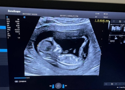 双顶径8.5生下来很小 双顶径8.5生下来很小