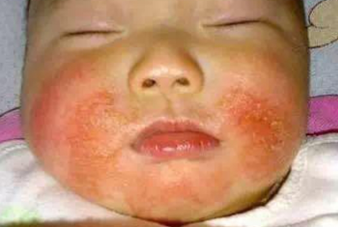 宝宝湿疹药膏十大牌子 宝宝湿疹药膏十大牌子