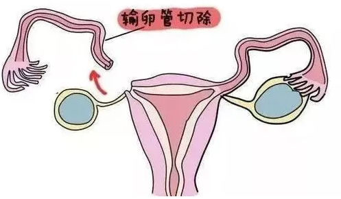 输卵管切除试管婴儿能做吗？