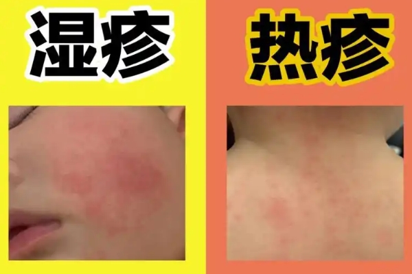 热痱子和湿疹红疹形态与痒感有差异