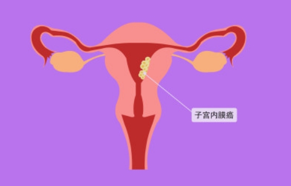 30岁得了早期子宫内膜癌还能做试管生孩子吗？