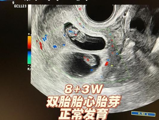 济南做试管婴儿医院:34岁小周三次移植失败后,终于等来胎心