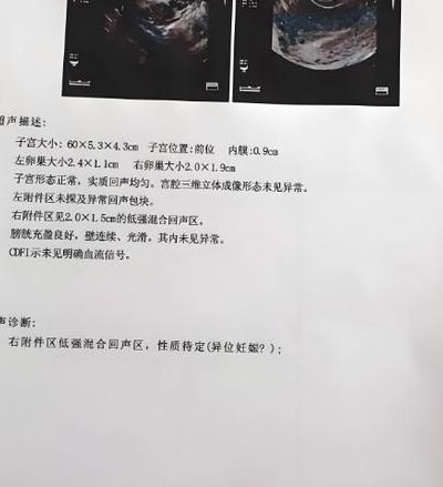 试管宫外孕几率大吗多少？约2%到5%，比自然怀孕略高