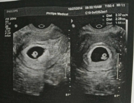 移植28天一超胎心胎芽有标准！孕囊大小也不可忽略
