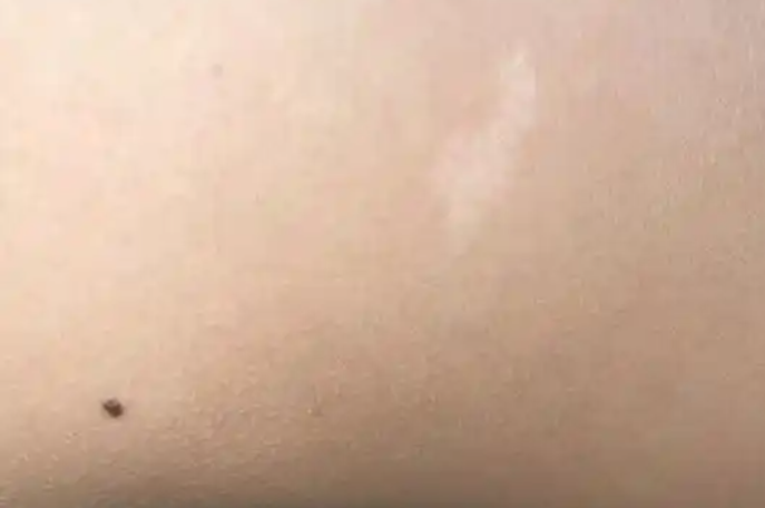 胎记代表运势是民间说法