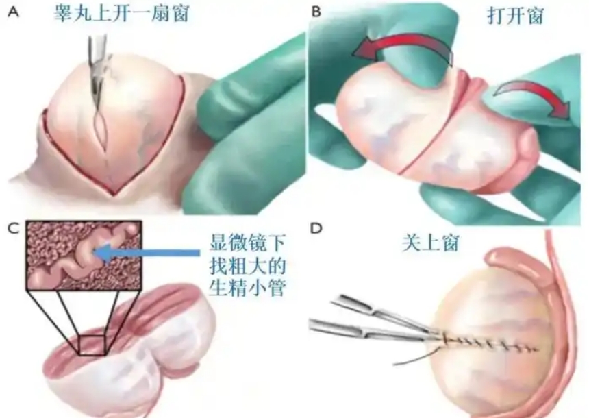 做试管男人怎样取精 做试管男人怎样取精
