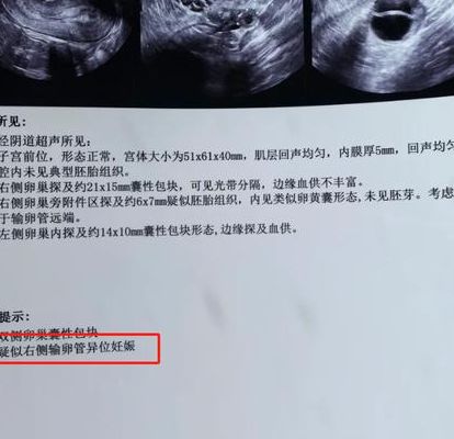 胚胎停止发育PK先兆流产：一个已无心跳，一个还能保，早孕出血别混淆