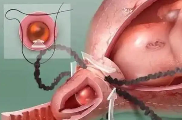 宫颈环扎术保胎成功率，一般可达70%-90%