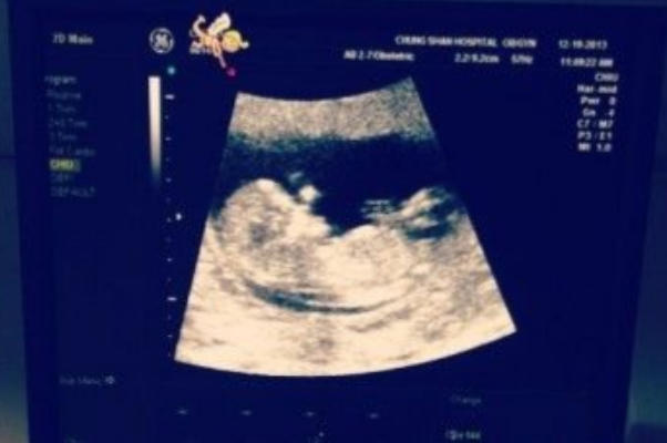 B超位置不好90%不一定是女孩