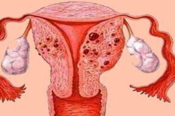 子宫内膜炎会导致膜状分泌物