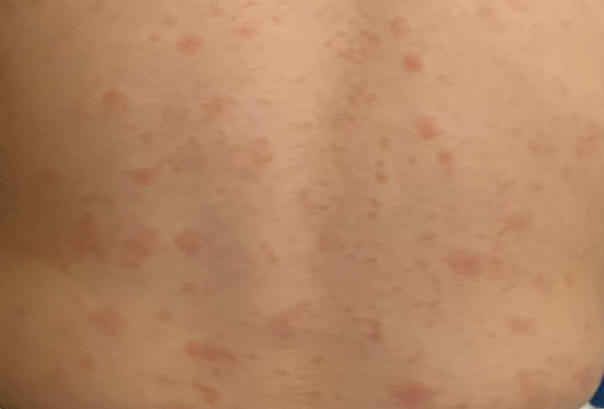 麻风疫苗副作用因人而异