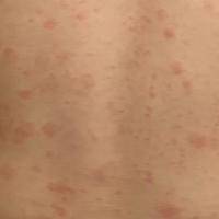 麻风疫苗起的红点图片，了解接种后的皮肤反应