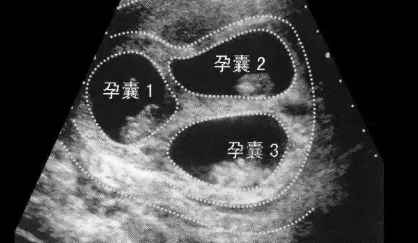 b超孕囊2个数看性别