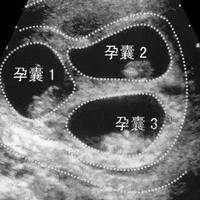 b超孕囊2个数看性别?形态特征的误读现象‌