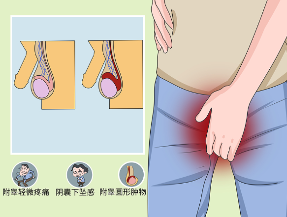 附睾头囊肿2.1cm可做试管