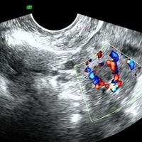b超结果显示卵巢左侧附件无回声区能进行试管促排吗？