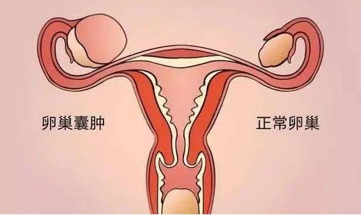 8厘米卵巢囊肿能做试管