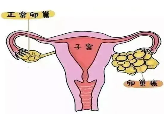 卵巢癌能做试管吗，卵巢问题对试管有何影响?