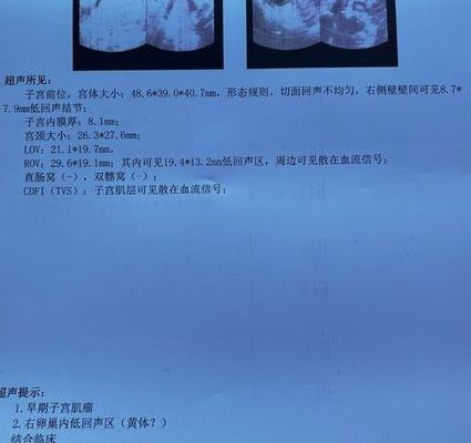2025宫外怀孕最佳处理方法变了：三份新指南给出答案