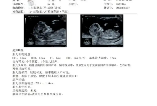 nt检查可判断胎儿是否畸形