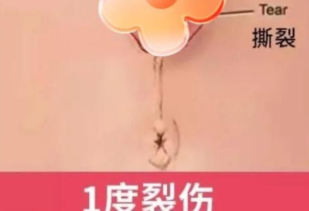 一度会阴裂伤