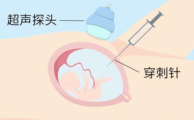 三代试管做羊水穿刺的风险