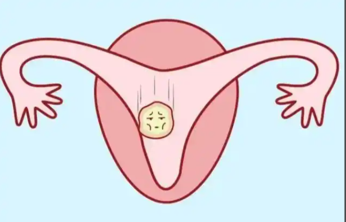 子宫肌瘤可能是激素水平失衡导致的