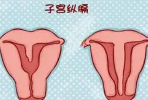 纵隔子宫怀孕不一定非常容易
