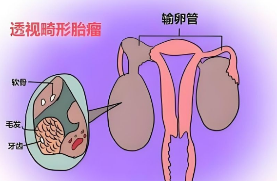 备孕前查出畸胎瘤的手术要求