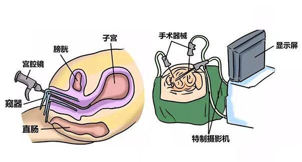 宫腔镜检查全过程图片