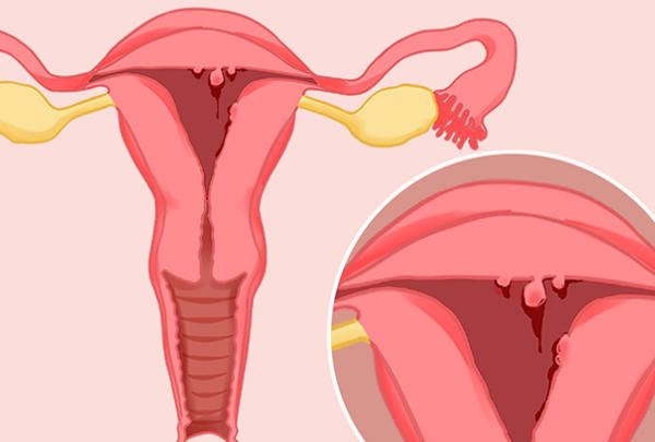 子宫内膜息肉手术后会有感染的风险