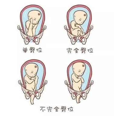 臀位的基本分型标准‌