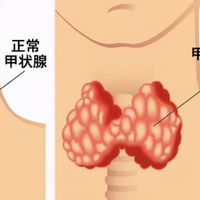 甲状腺左侧囊肿影响试管婴儿吗?