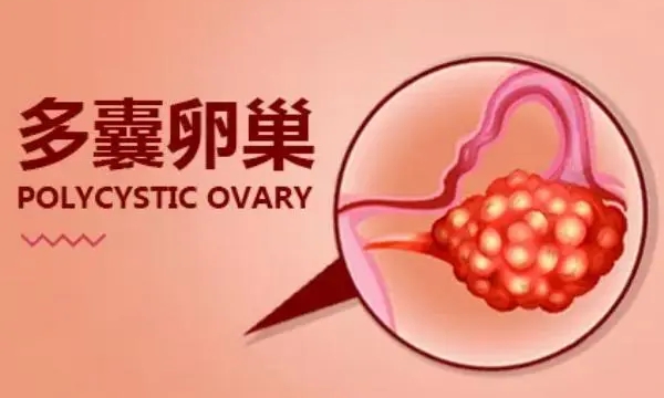多囊卵巢试管怀孕后容易胎停育因为内分泌?