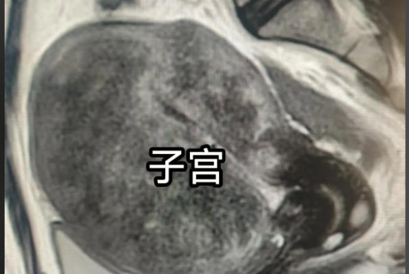 子宫萎缩会影响女人<a href=