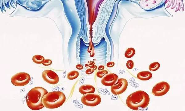 撤退性出血有血块的状况