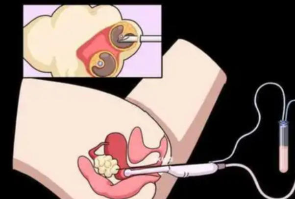 取卵手术时长受卵泡个数影响