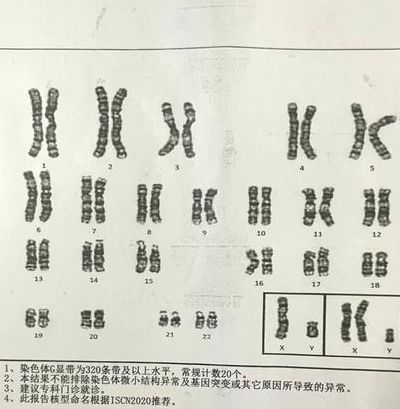染色体有47条会有哪些疾病？常见5类综合征一次说清