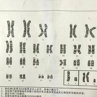 染色体有47条会有哪些疾病？常见5类综合征一次说清