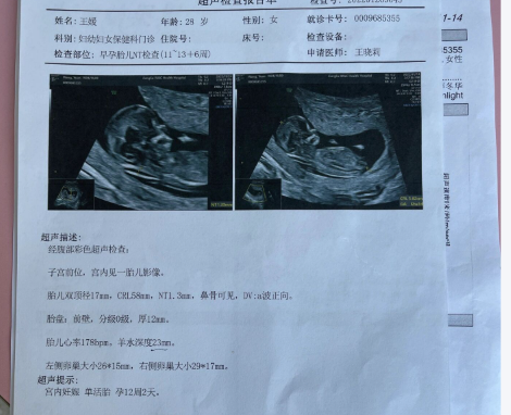 大于1.5cm怀男孩的可能性大