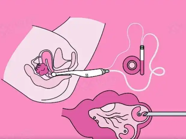 取卵后轻度腹水可以自愈