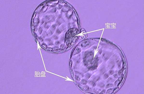 三代试管筛选出5bb的囊胚