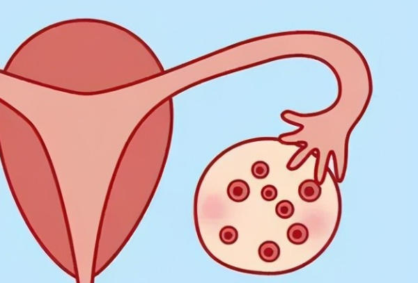 多囊卵巢会导致月经紊乱