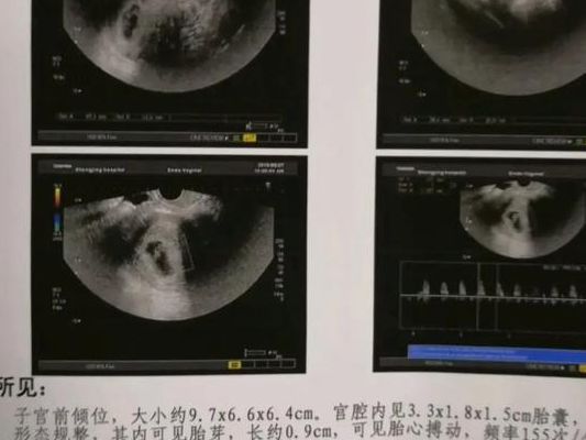人粒细胞刺激因子对试管移植的作用：两次失败后，我终于等来了胎心