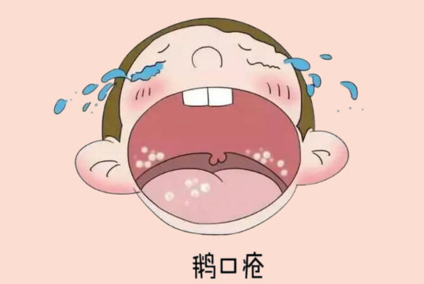 鹅口疮和马牙的成因不同